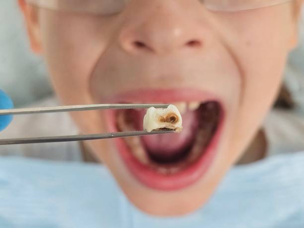 Best Emergency Tooth Extraction in Citrus City, TX